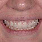 COI Clinica Dental Granollers - Estetica Dental - Coronas dentales de ceramica