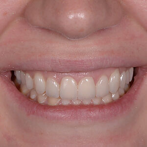 COI Clinica Dental Granollers - Estetica Dental - Coronas dentales de ceramica