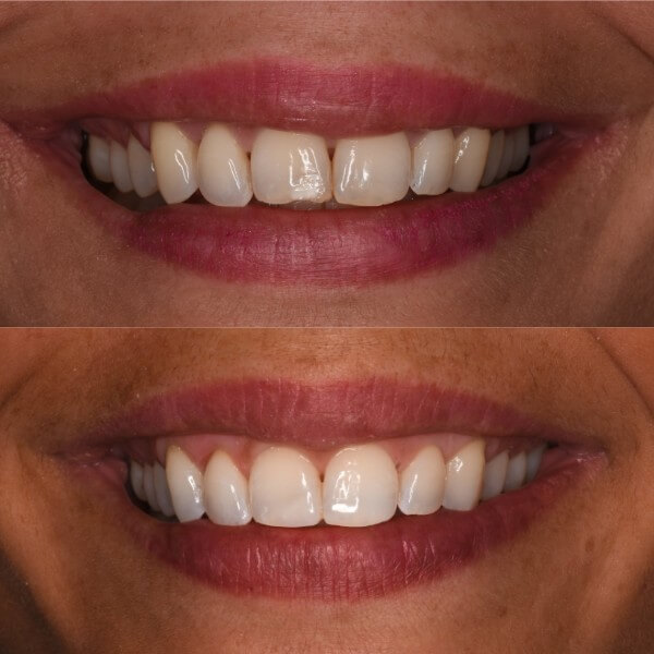 Blanqueamiento dental en Granollers