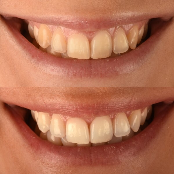 Blanqueamiento dental en Granollers
