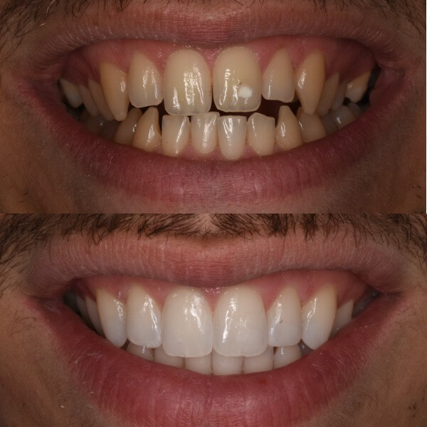 Blanqueamiento dental en Granollers
