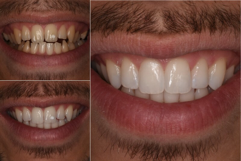 Blanqueamiento dental con reconstrucción estética