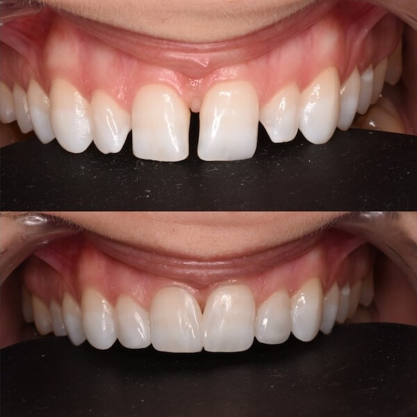 Diastema - Estética Dental Granollers