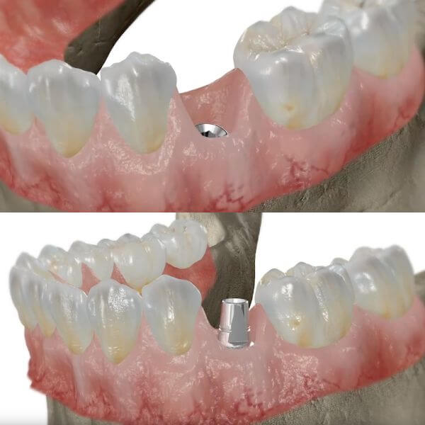 Ejemplo de implante dental en Granollers