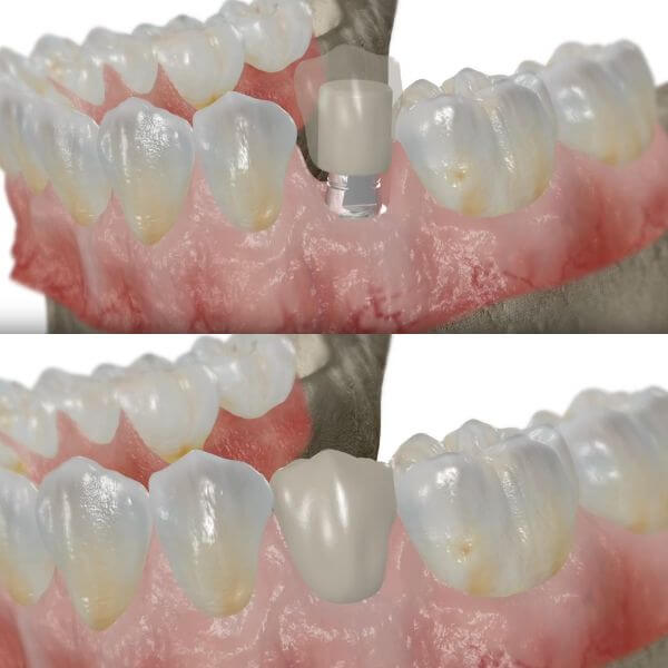 Ejemplo de implante dental en Granollers