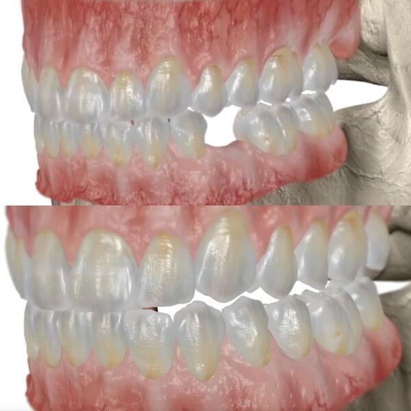 Ejemplo de implante dental en Granollers