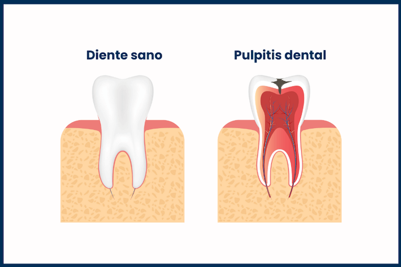 Ejemplo de pulpitis dental