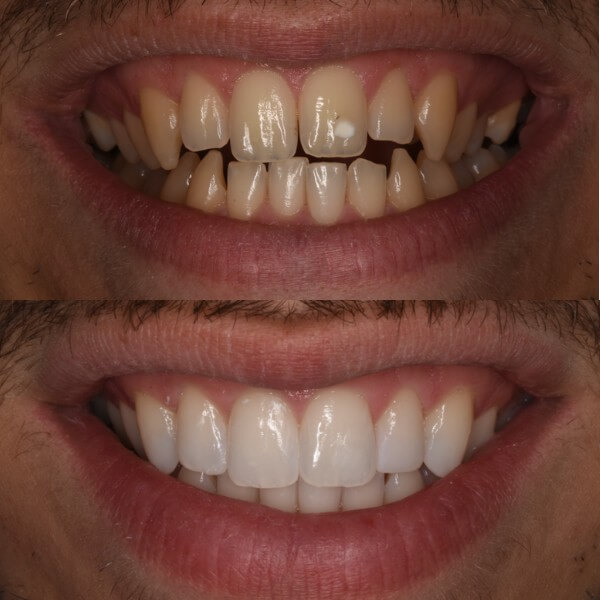 Blanqueamiento y carillas - Estética Dental