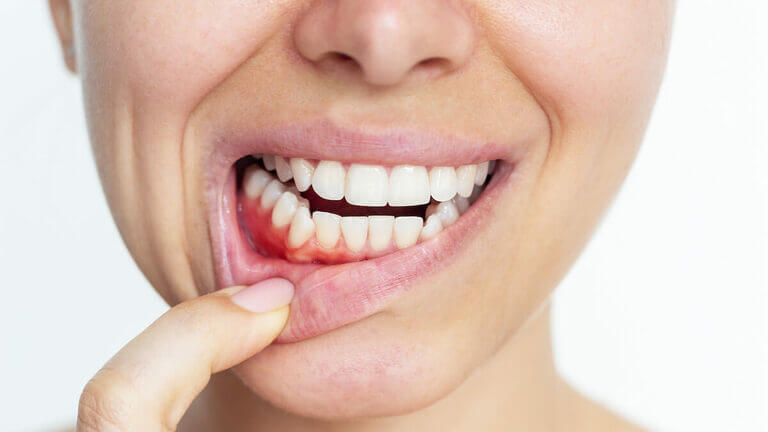 ¿Qué es la gingivitis y cómo tratarla?