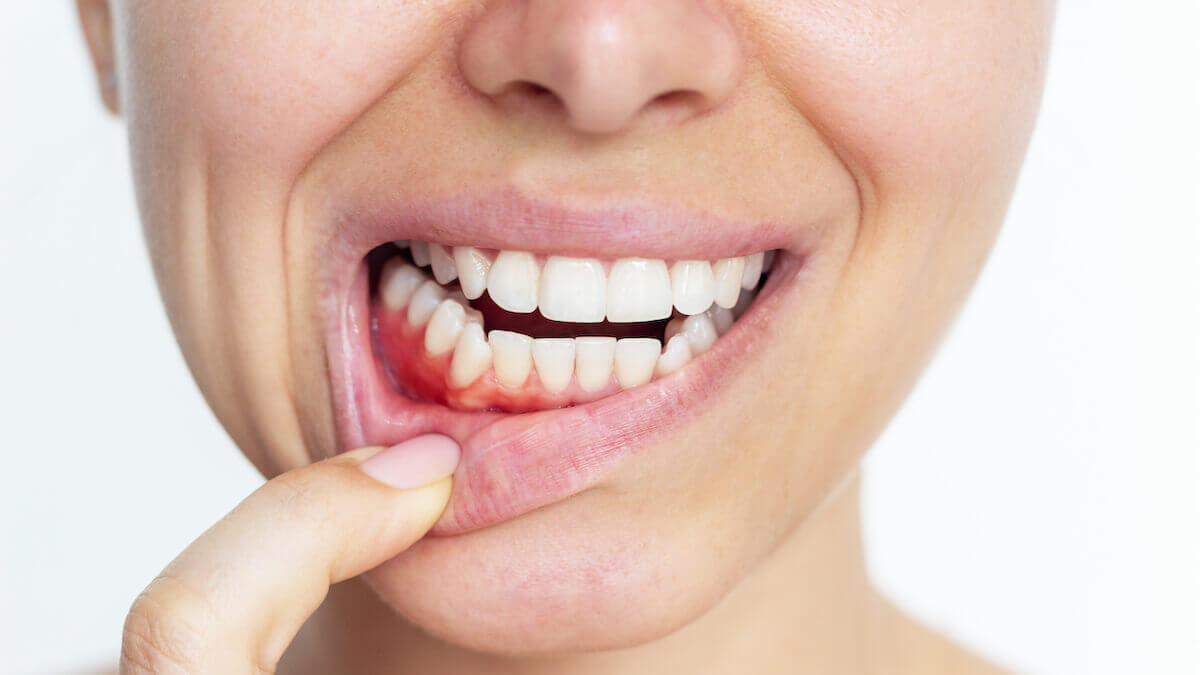 ¿Qué es la gingivitis y cómo tratarla?