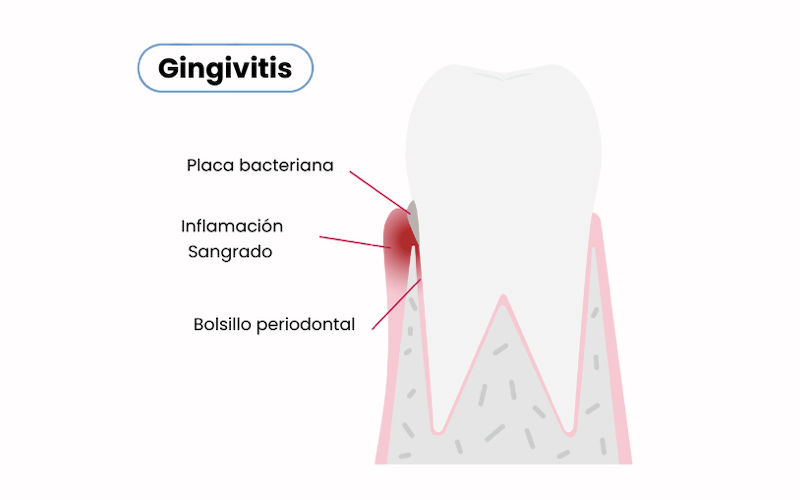 ¿Qué es la gingivitis?