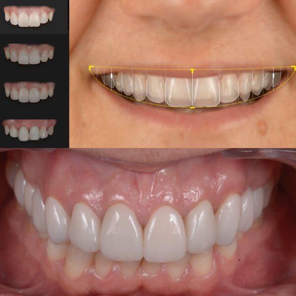 Puentes dentales Granollers