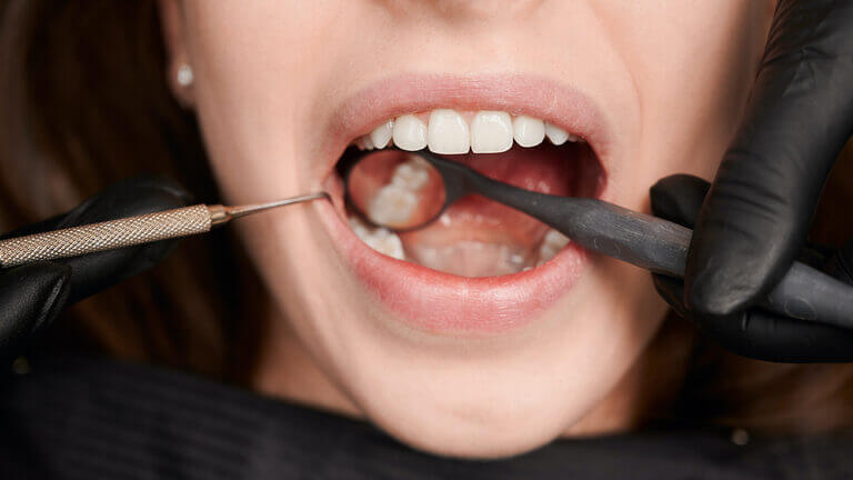 Pulpitis dental ¿qué es y cuáles son sus tratamientos?