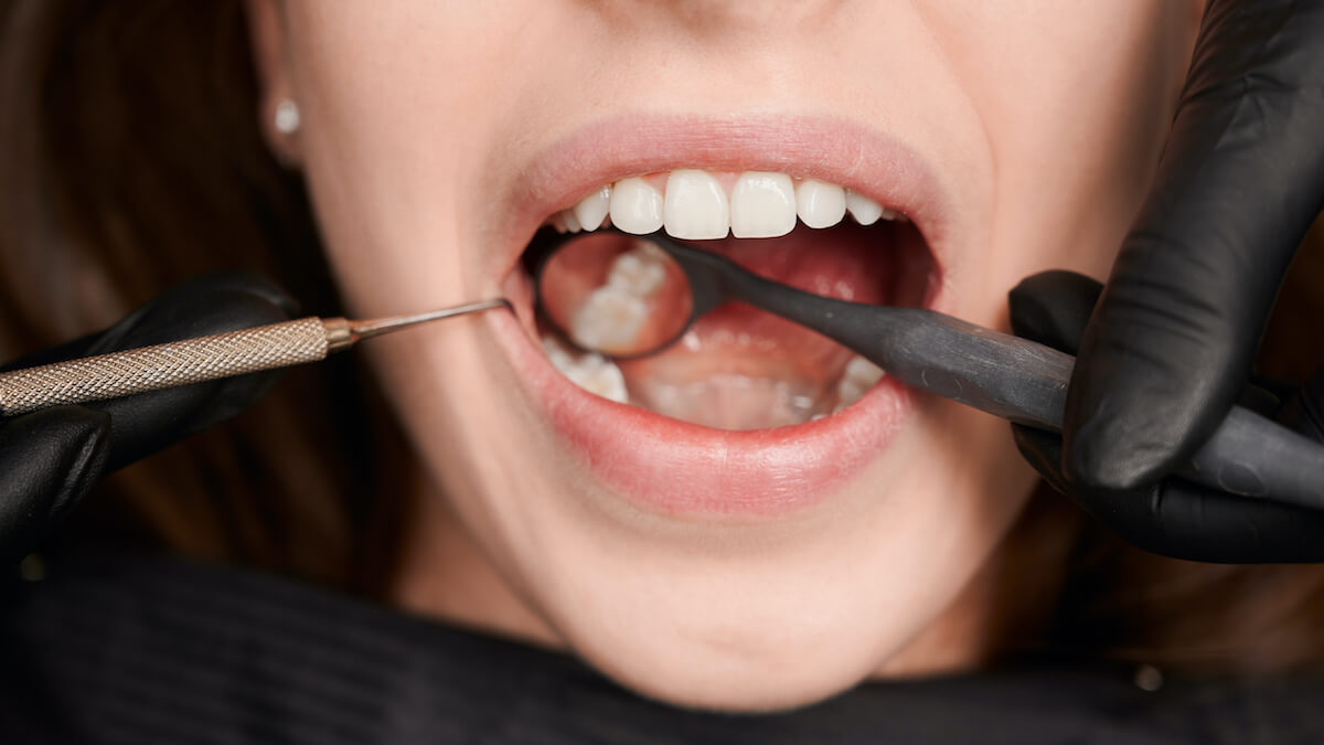 Pulpitis dental ¿qué es y cuáles son sus tratamientos?