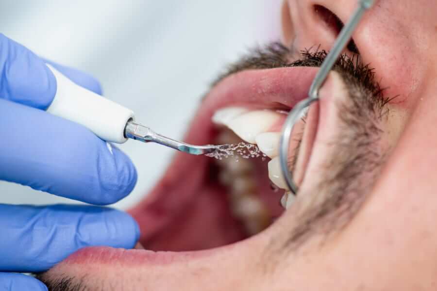 ¿Qué es una limpieza dental profesional?