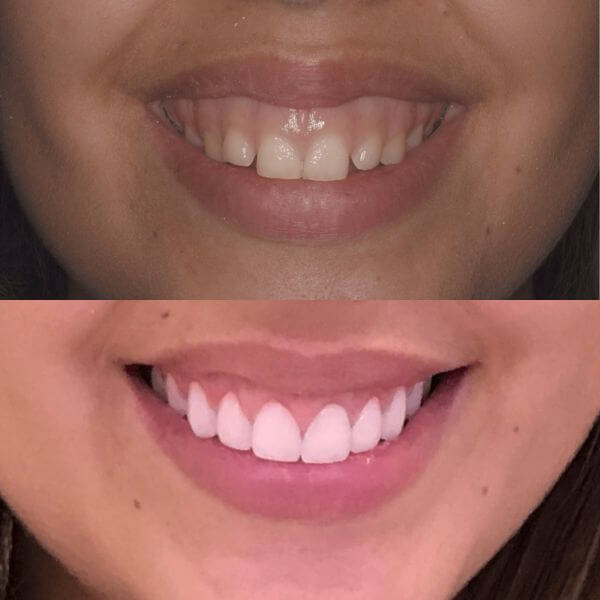 Sonrisa gingival - Alargamiento coronario