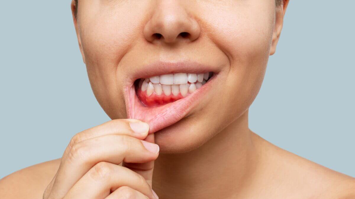 Apariencia de encías inflamadas