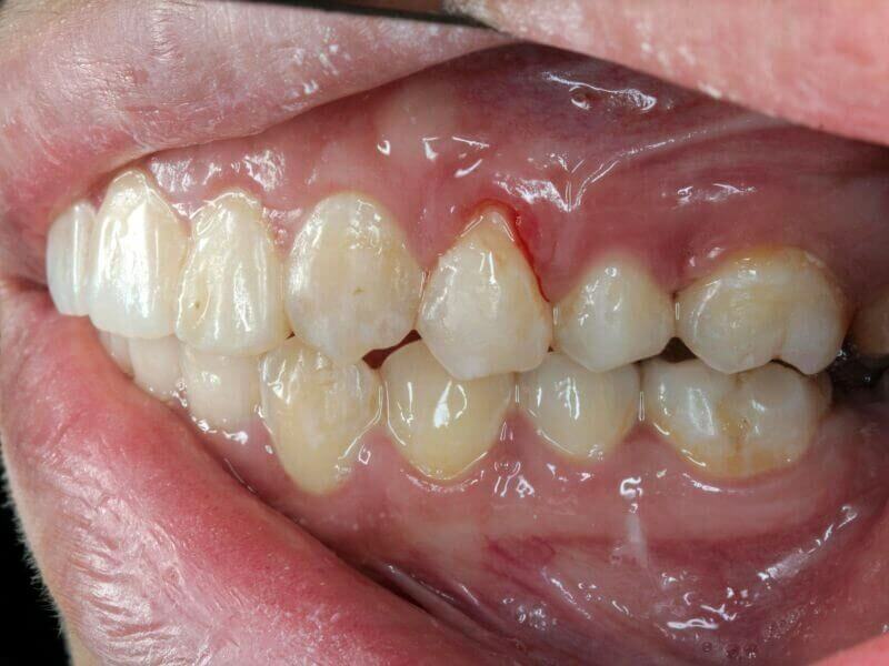 Causas de las encías inflamadas
