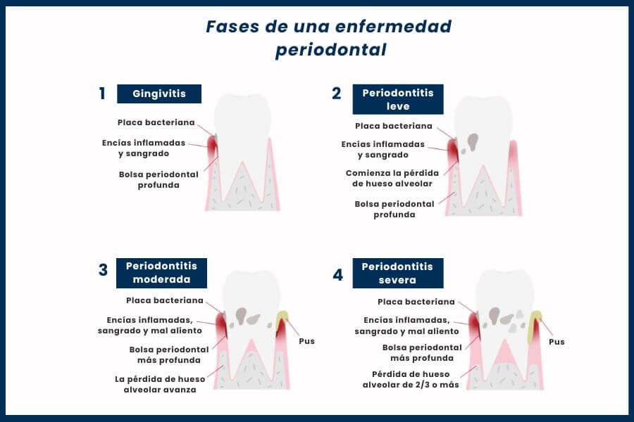 Fases de la enfermedad periodontal