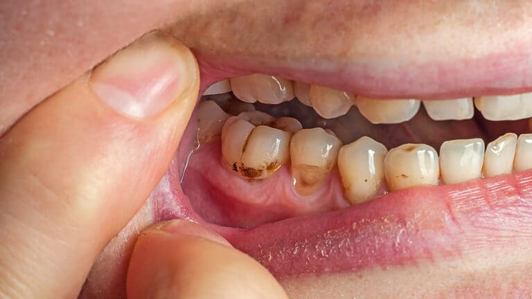 Manchas en los dientes causas y solución
