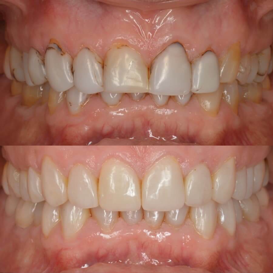 tipos de manchas dentales - Antes y después