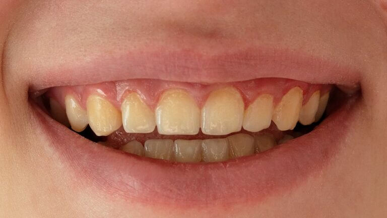¿Cuáles son las causas de los dientes amarillos?