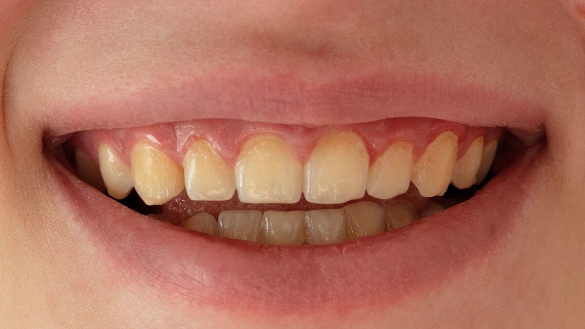 ¿Cuáles son las causas de los dientes amarillos?