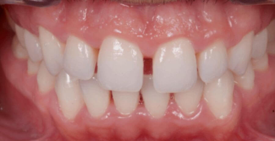 Paciente con diastema dental central - 1