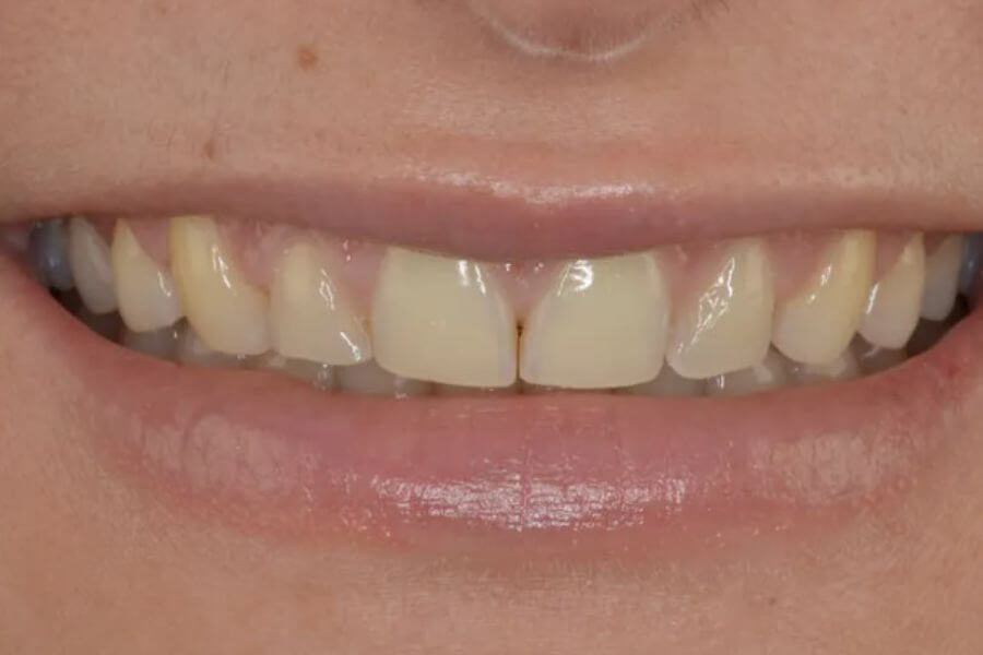 Paciente falta estética dental