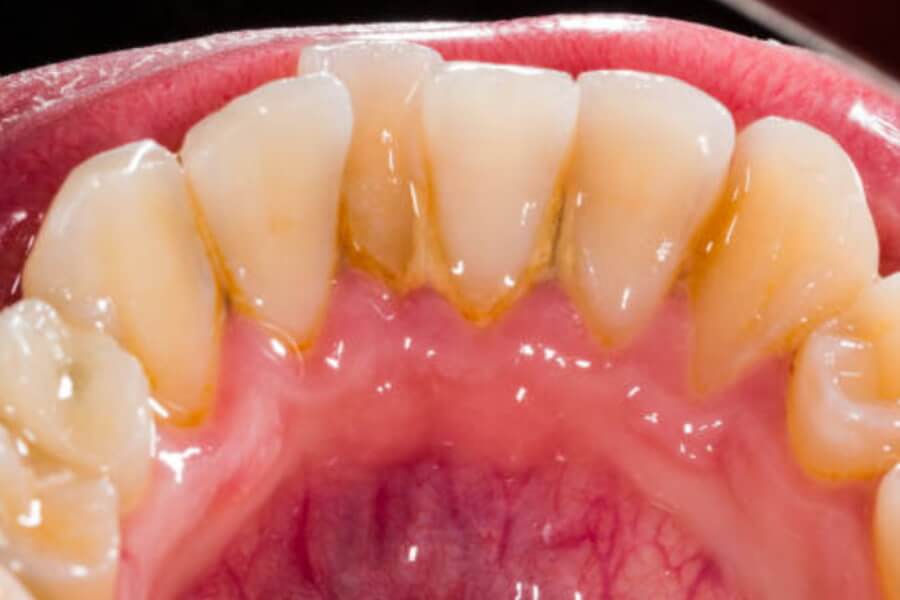 Qué es el sarro dental