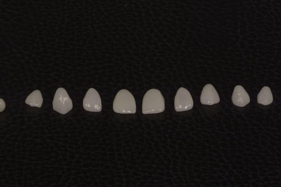 Tipo de carillas dentales cerámica