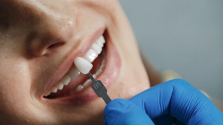 ¿Qué tipos de carillas dentales existen?