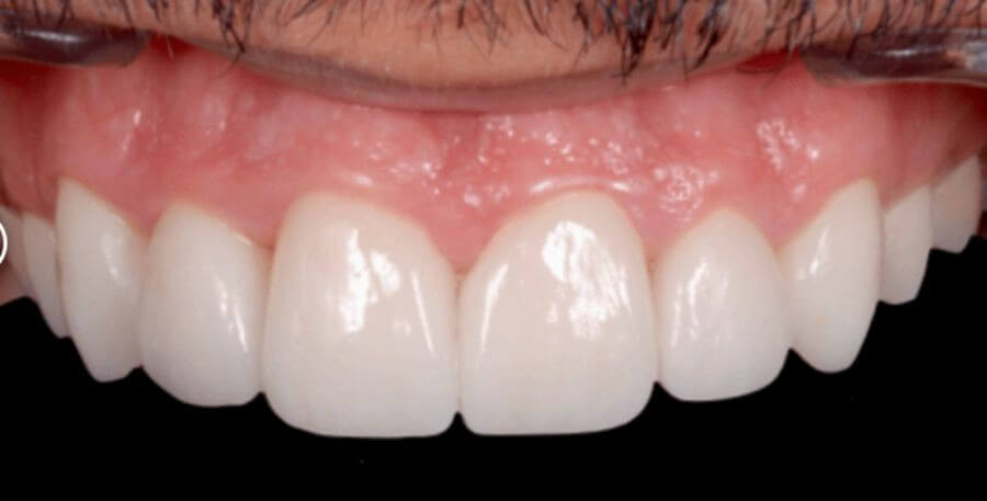 Tratamiento diastema con carillas de porcelana