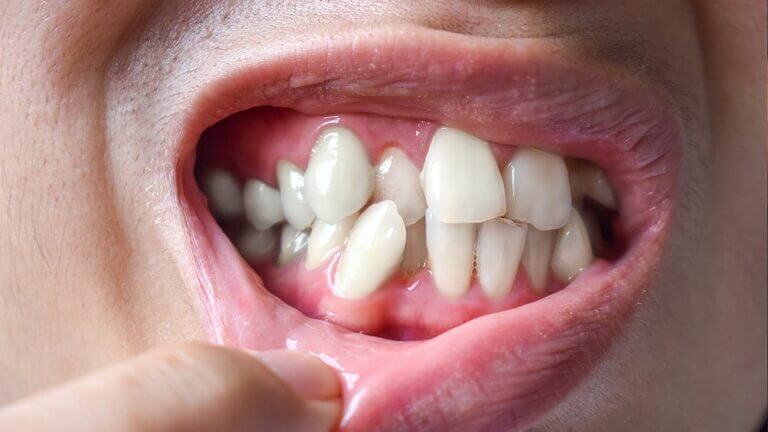 Boca con dientes apiñados