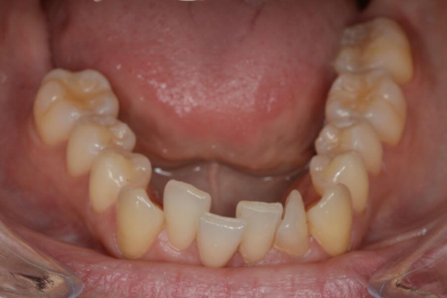 Boca con dientes apiñados inferiores
