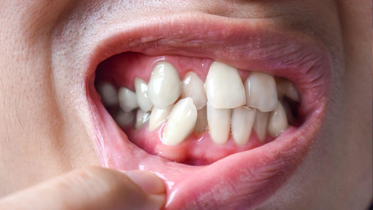 Boca con dientes apiñados