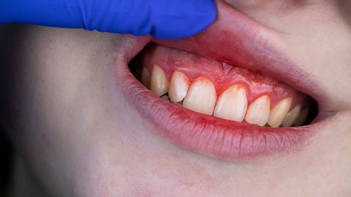 Boca con sangrado de encías