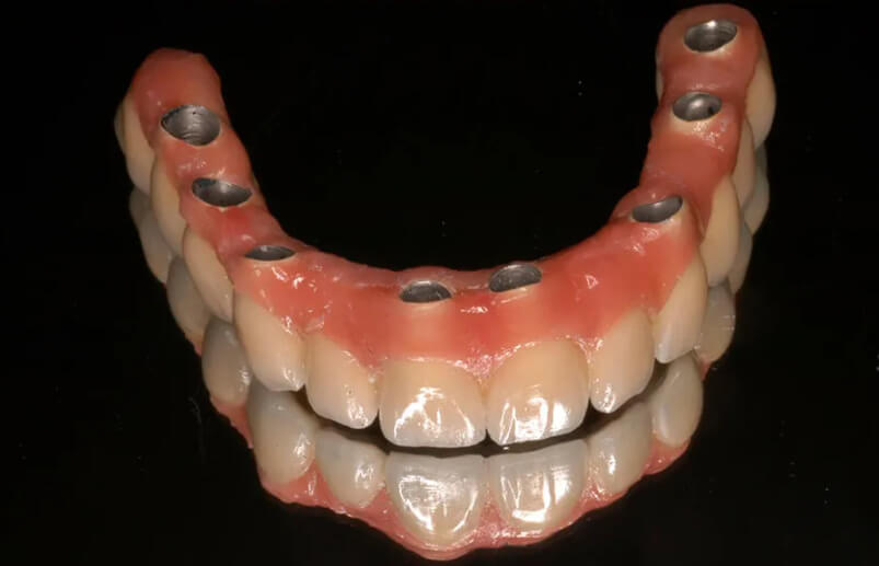 Qué es una prótesis dental
