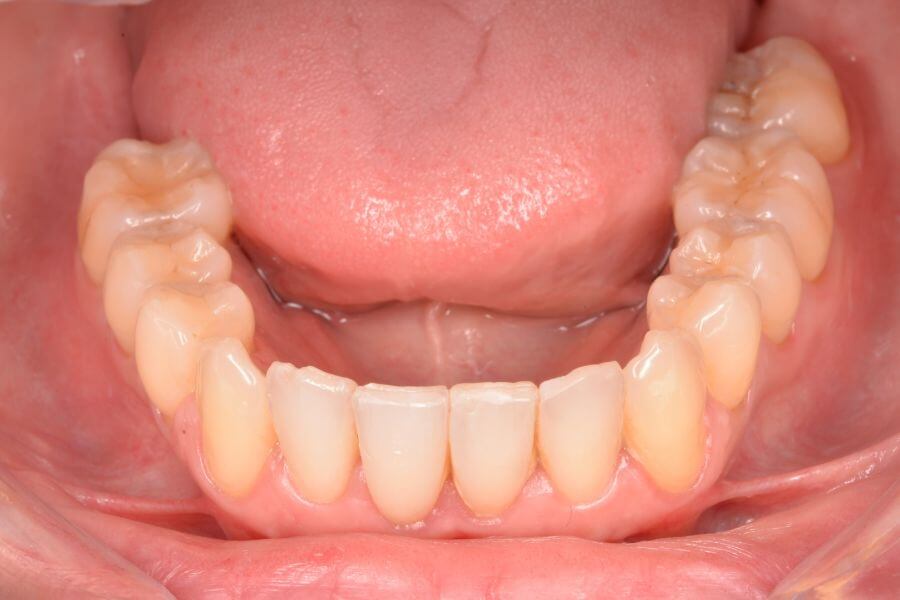 Tratamiento para dientes apiñados