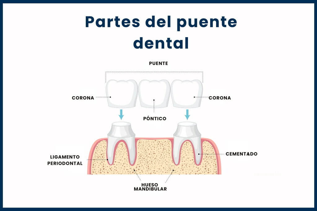 Partes de los puentes dentales