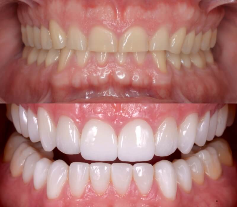 Reconstrucción dental antes y después de desgaste de dientes