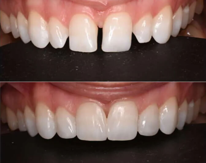 Antes y después de una maloclusión como el diastema