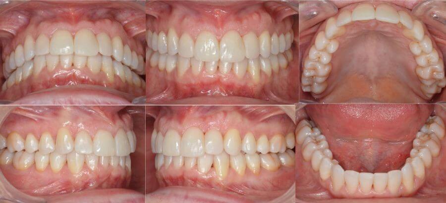 Después de realizar ortodoncia invisible con corticotomías