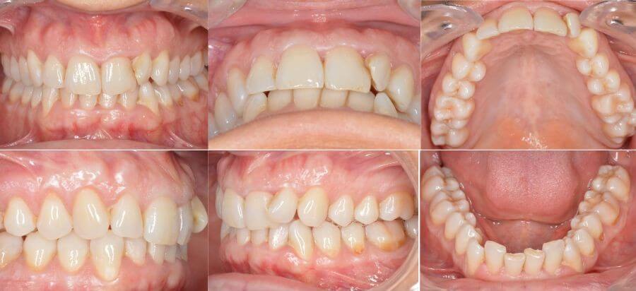 Maloclusión, apiñamiento dental y desgaste 