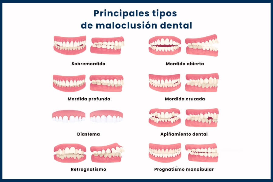 Clasificación de una maloclusión dental