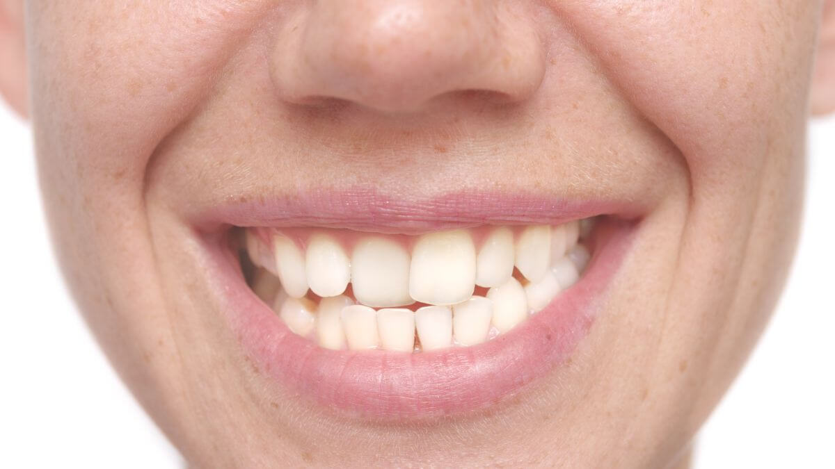 Tipos de maloclusión dental