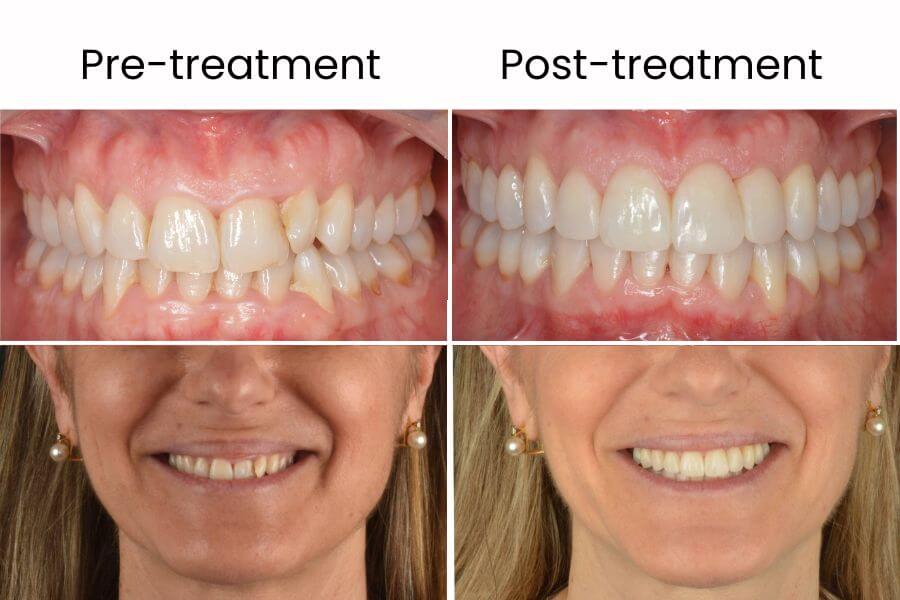Antes y después de un tratamiento de ortodoncia invisible en adultos