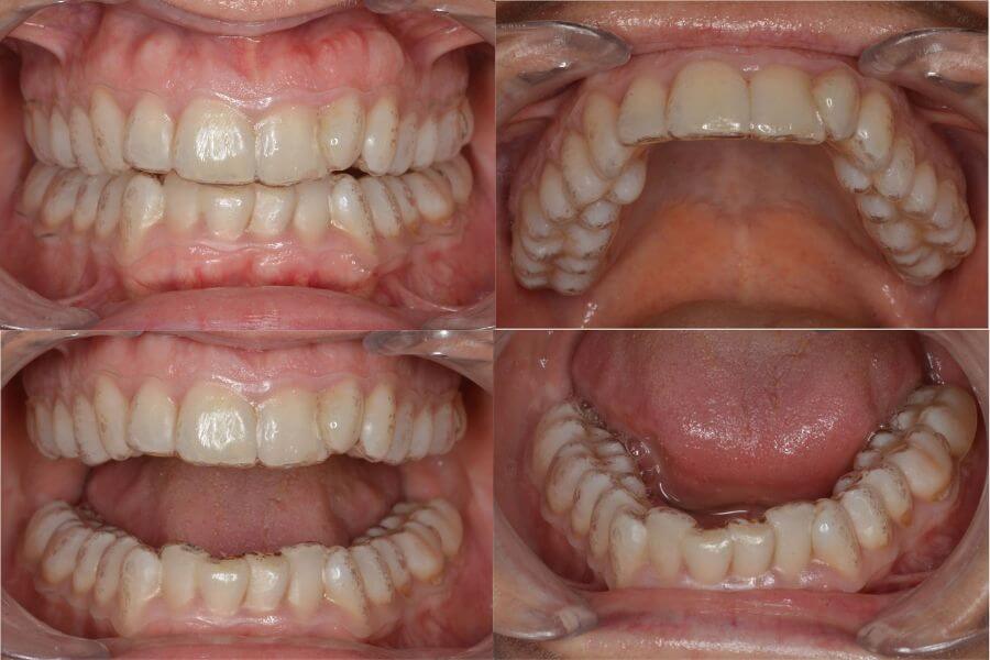 Tratamiento de ortodoncia invisible con FAS Aligners System