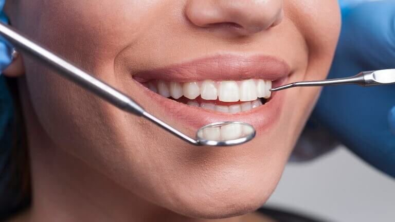 blanqueamiento o carillas dental