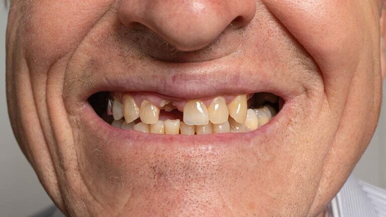 Qué es el edentulismo o la pérdida de dientes
